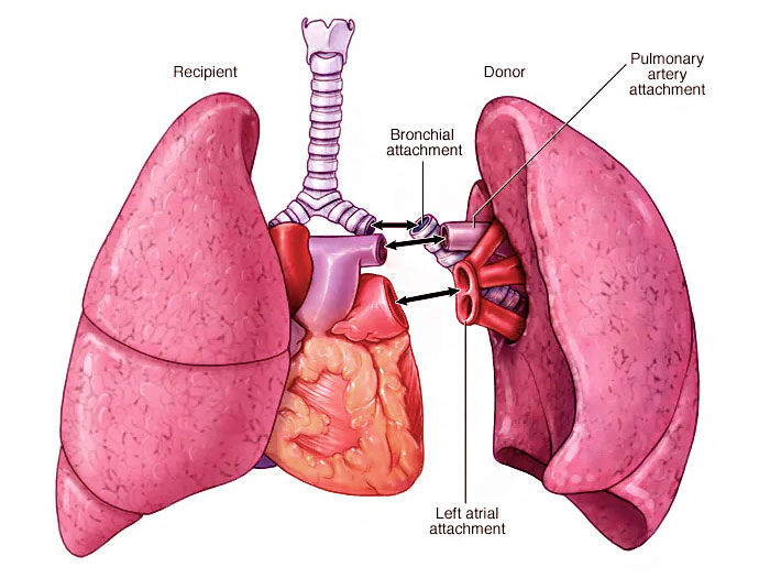 Lung Transplant