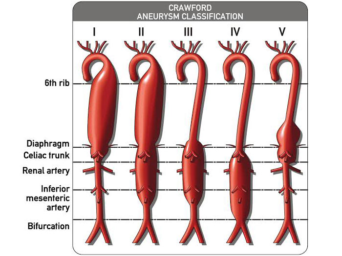 Aortic Surgery