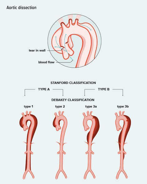 Aortic Surgery in Prabhadevi | Dr. Vishal N. Pingle