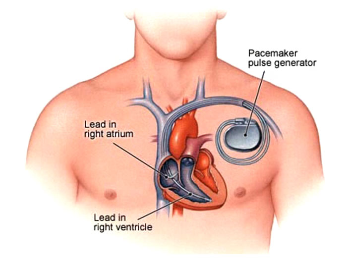 Pacemaker Implantation